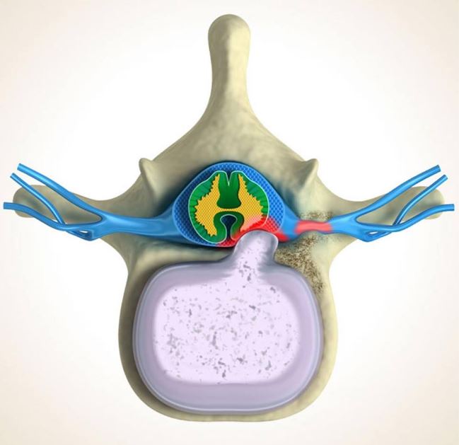 Herniated Discs - Midwest Orthopedic Consultants