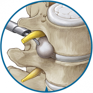 Endoscopic Foraminotomy | Scottsdale, AZ Orthopedic Spine Surgery