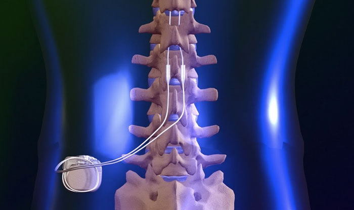 dorsal column stimulator technique
