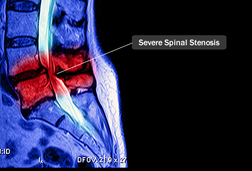 Spinal Stenosis: What It Is and How We Can Treat It